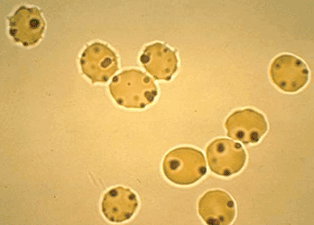 Image: Heinz bodies in erythrocytes indicative of G6PD-deficiency (Photo courtesy of Institute of Tropical Medicine).